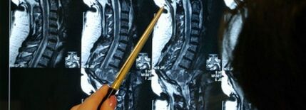 Skrytá zlomenina obratle a epidurální hematom u pacienta s ankylozující spondylitidou: kazuistika