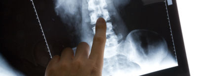 Péče o pacienty s ankylozující spondylitidou po úrazech