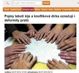 Pojmy labutí šíje a knoflíková dírka označují i deformity prstů