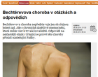 Bechtěrevova choroba v otázkách a odpovědích