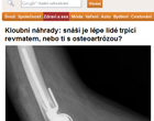 Kloubní náhrady: snáší je lépe lidé trpící revmatem, nebo ti s osteoartrózou?