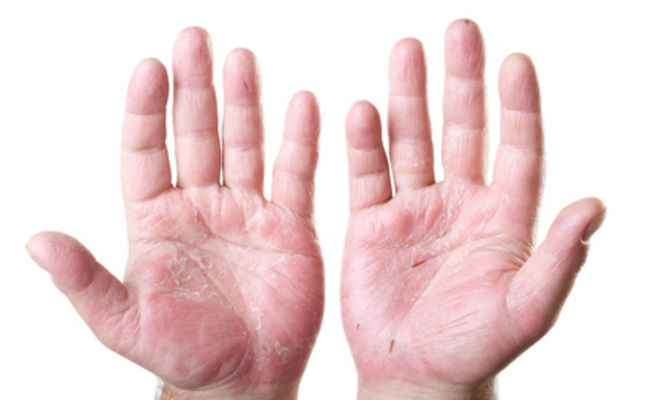 Psoriáza a artritida – jak patří k sobě?